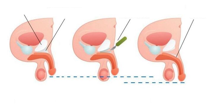 penis enlargement after surgery